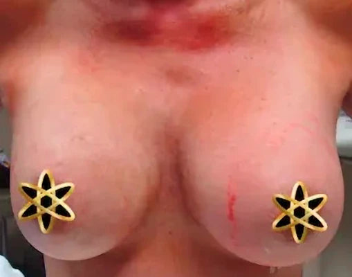 woman's chest after implants