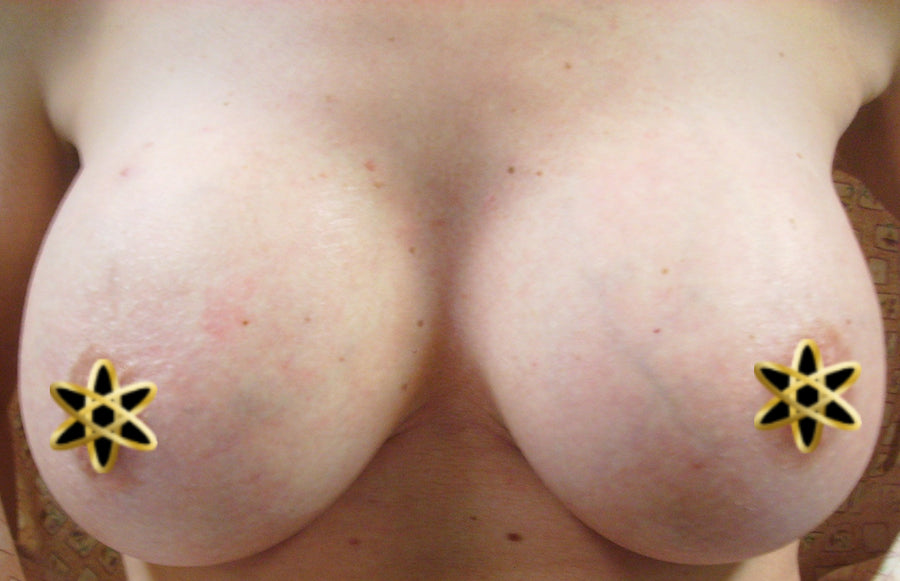 breast implants after they have settled