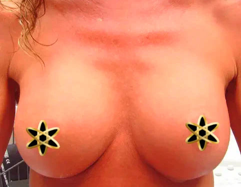 woman's chest after breast implants
