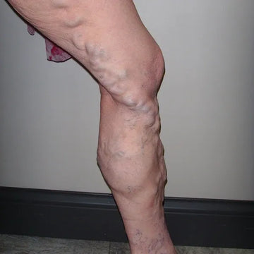 left leg of elderly woman with very large varicose veins