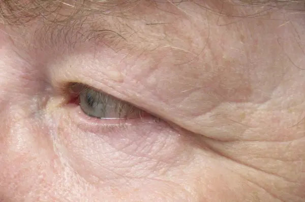 before surgery heavy eyelid left