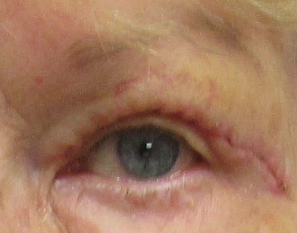 left eye close up after upper eyelid surgery