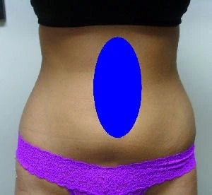 female abdomen front view after liposuction several weeks later