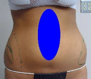 female abdomen marked before liposuction on the flanks