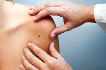 pigmented raised 7 mm mole irregular on the front of the left shoulder in female