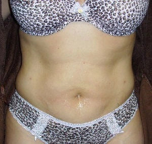 Leopard print lingerie set on a plain background several weeks after laser liposuction