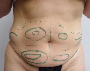 Person's abdomen with green markings on a plain background before laser liposuction