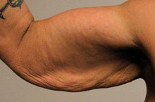 link to arm, breast, tummy, eyelid lifts