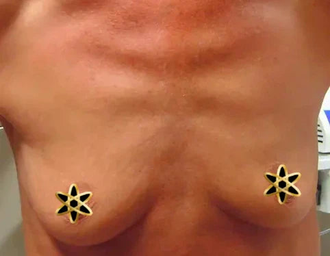 before breast implants woman's chest