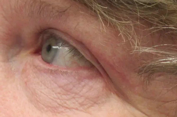 eyelid surgery post op woman's left eye