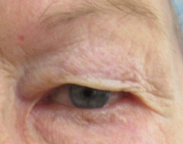 left eye close up before upper eyelid surgery
