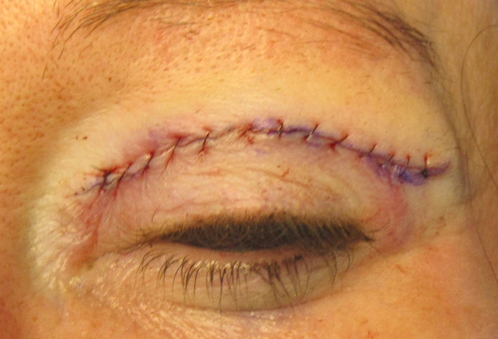 left upper eyelid with sutures immediately after a blepharoplasty
