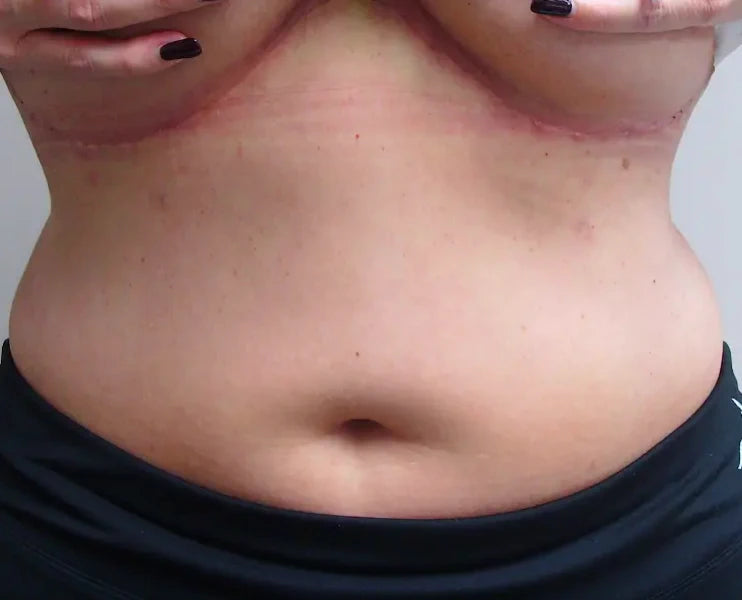 photo of a tummy after liposuction and an upper tummy lift