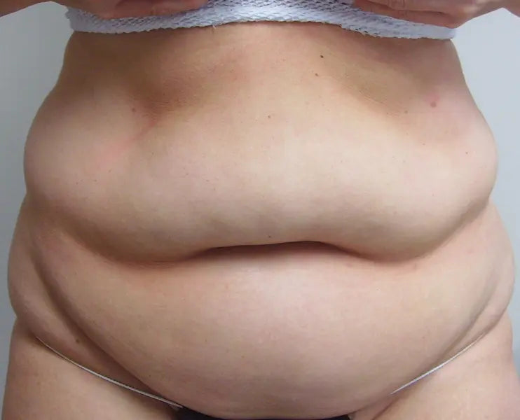 view of a tummy before liposuction and an  upper tummy lift