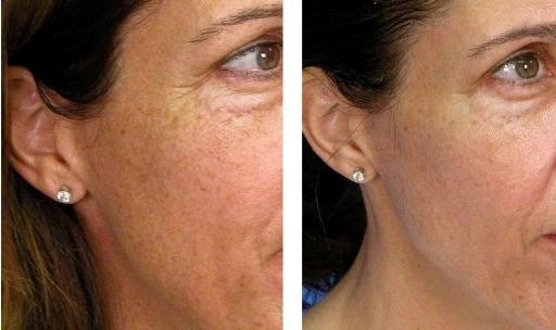 female face before and after image showing the changes from a light laser peel