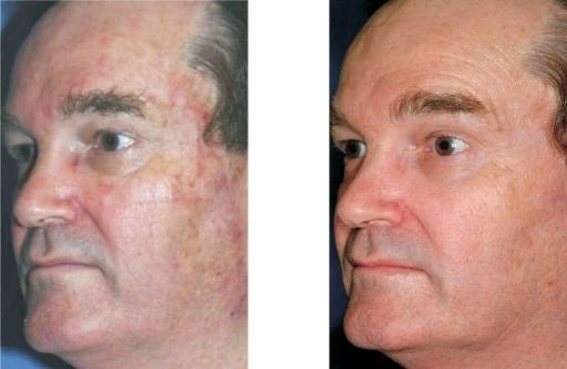 male face left side before and after a moderate power laser peel