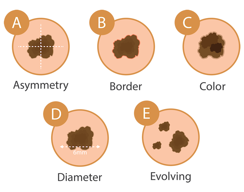 diagram of indications for mole biopsy