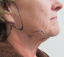 View face lift page