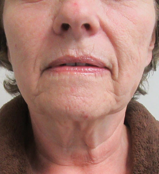 woman's lower face before S Lift