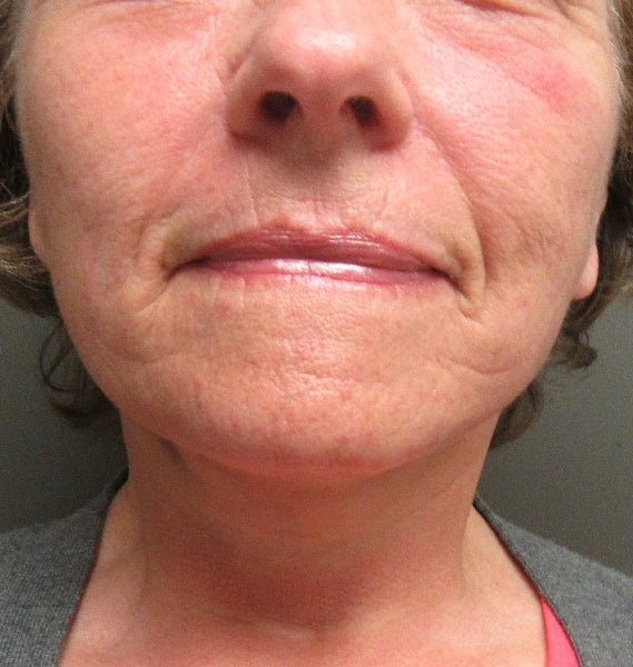 woman's lower face front view after S Lift