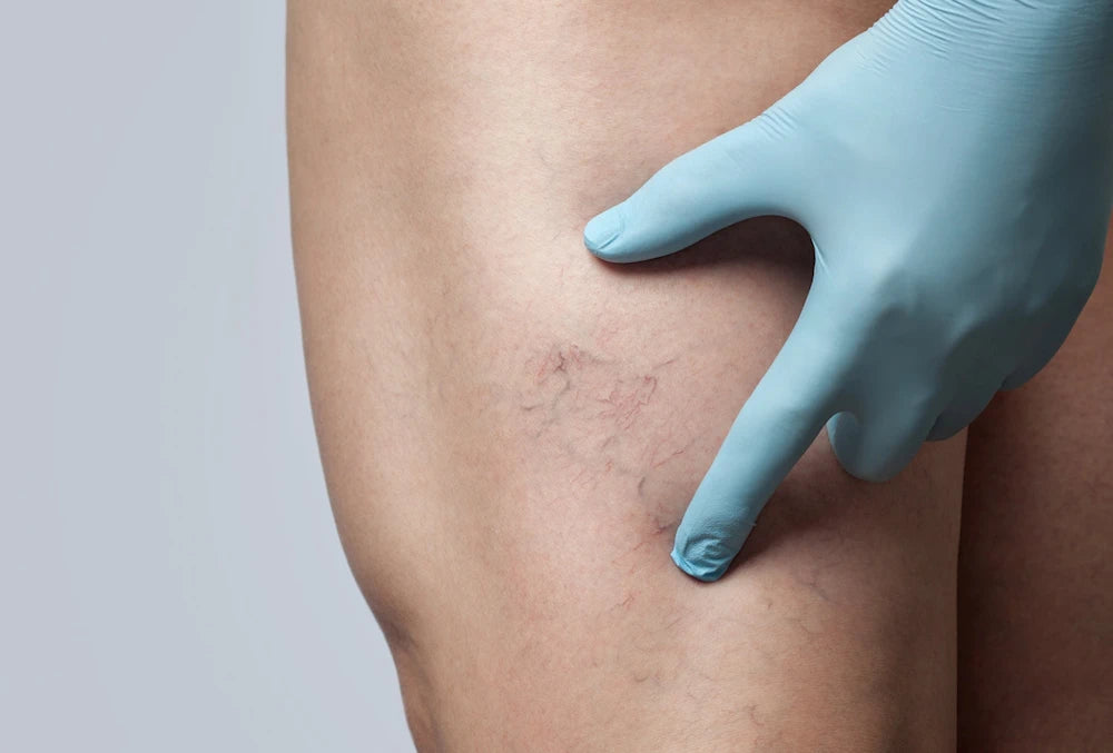 lateral thigh with spider vein cluster