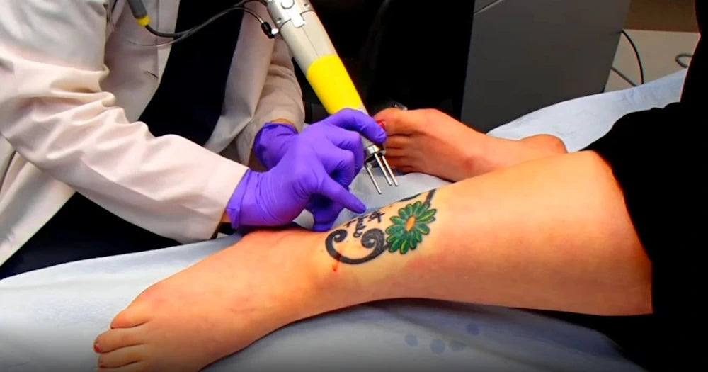 Person getting tattoo removal on the side of the right ankle .