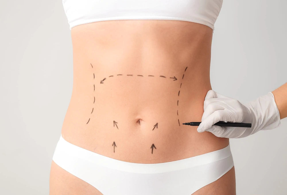 Person's waist with surgical lines drawn on it, wearing a white bra and underwear set.