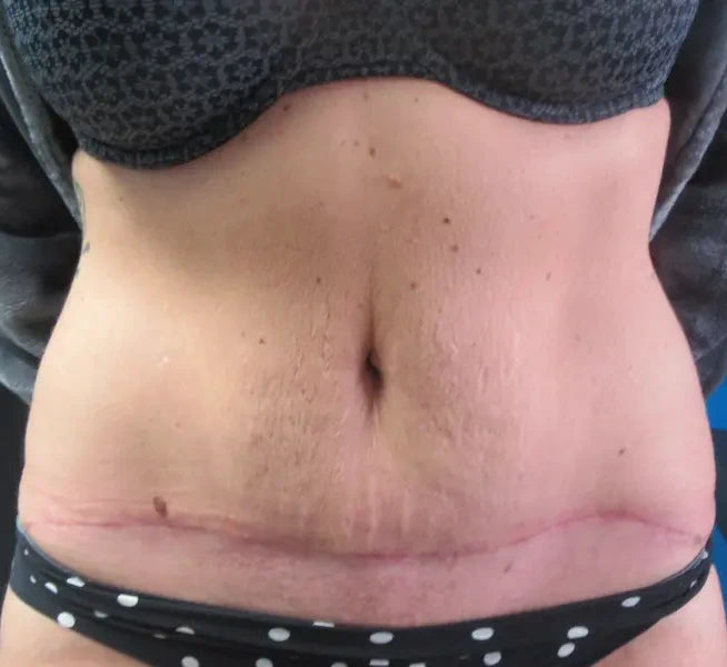tummy after a lower tummy tuck with umbilicoplasty