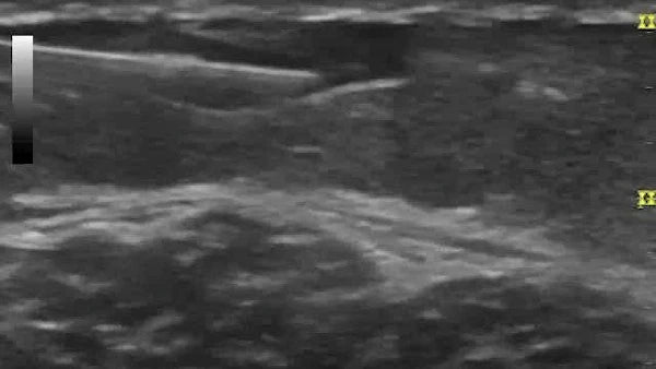 ultrasound image of needle inside of a superficial varicose vein for sclerotherapy