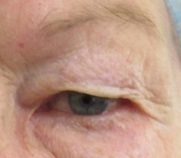 close up of the left upper eye in patient who needs a blepharoplasty